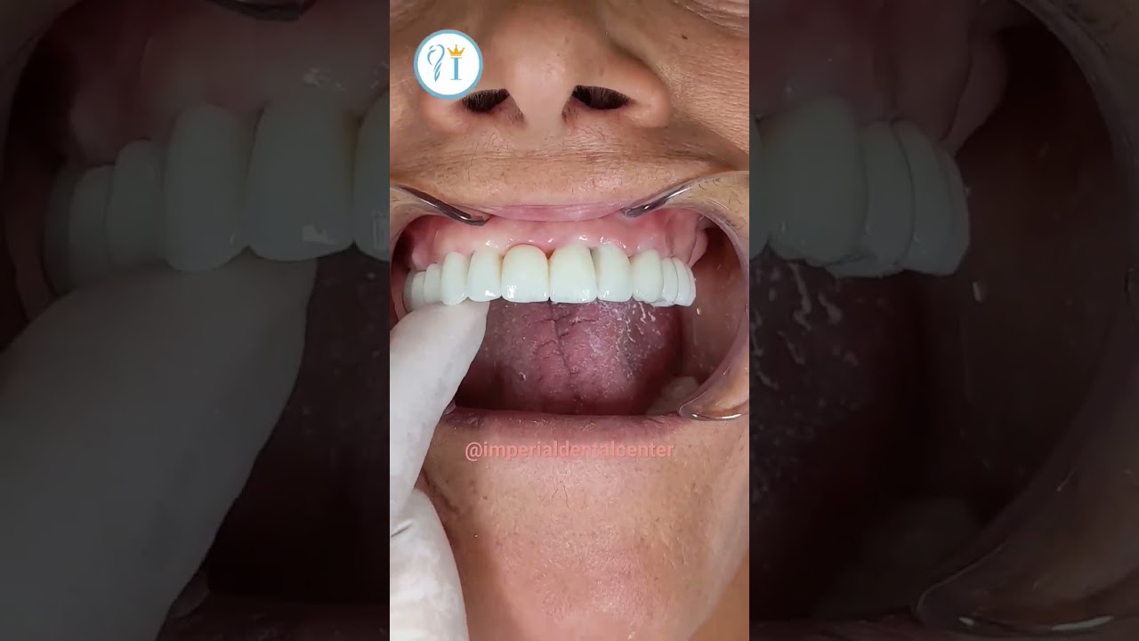 Zirconia Bridges on Dental Implants. Corone in zirconia su impianti dentali. #shorts