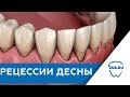 Рецессии десны