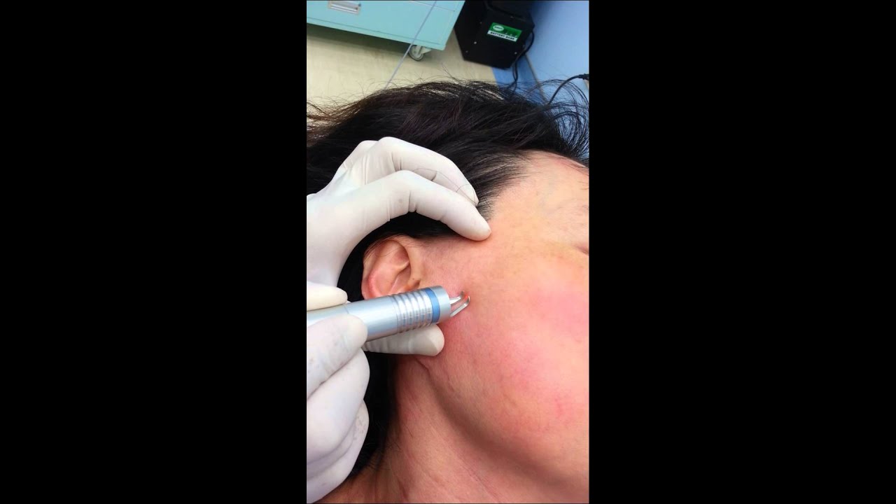 Laser treatment for facial spider vein 陳建彰診所 / 宇成診所 靜脈曲張專科診所 YouTube