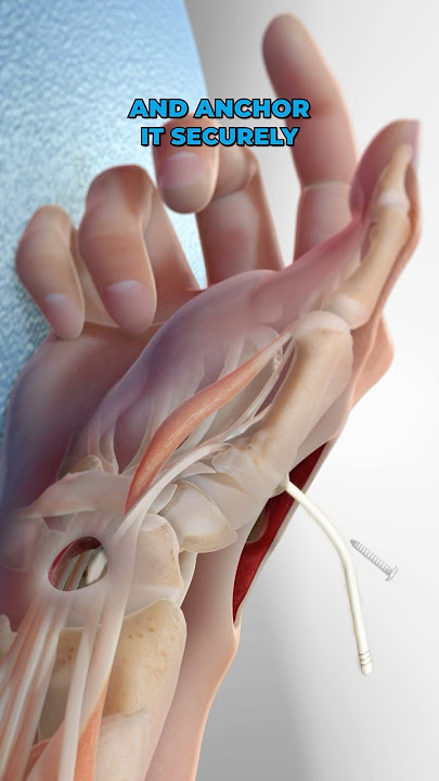 Basal Joint Surgery (3D Animation)