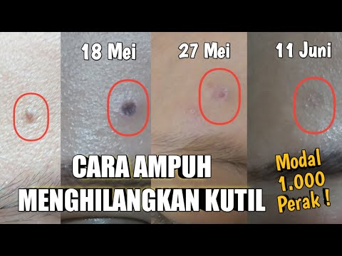 CARA AMPUH MENGHILANGKAN KUTIL DI WAJAH DAN BADAN | PENGALAMAN PRIBADI | #oktaekarosdiana