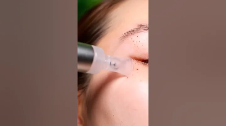 Most Satisfying Blackhead Vacuum Cleaning Ever Made