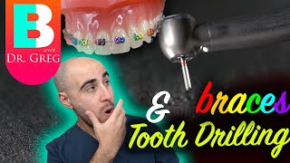 Braces & Teeth Drilling?! 5 Reasons Why