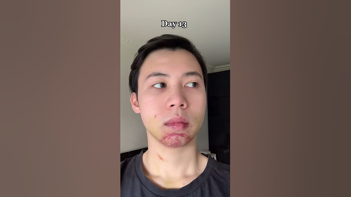 Jaw Surgery Transformation #2