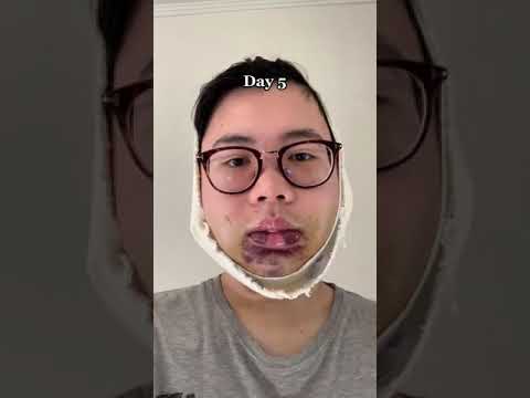 Jaw Surgery Transformation 2