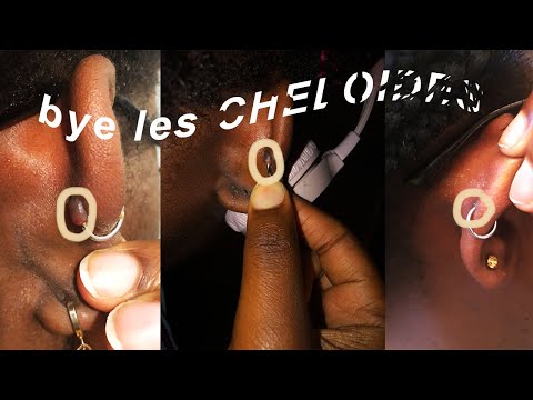 Vidéo: Bouton Sur Le Lobe De L'oreille: Causes, Traitements Et Piercings
