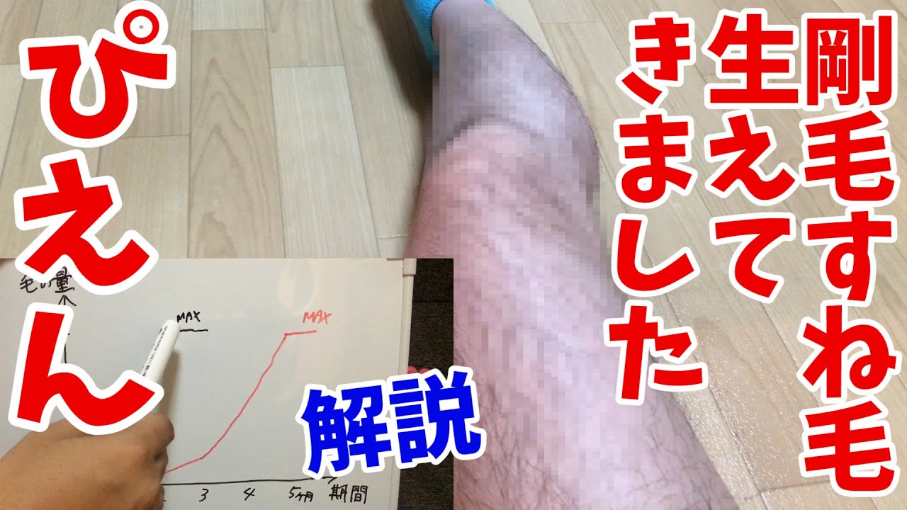 ケノンの脱毛効果を解説します！剛毛すね毛生えてきました…ぴえん。【脱毛器５ヶ月後の毛の状態】