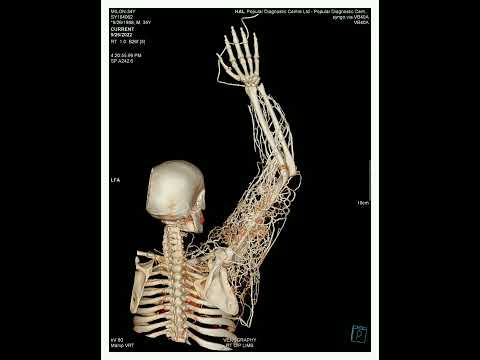 upper Limb venogram
