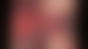 Simplified ridge and sinus augmentation using StickyboneTM2010  and Sohn