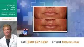 Ask the Derm: Dr. Groff Discusses Lasers, Skin Cancer, Brown Spots, and Fillers