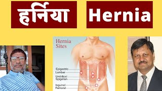 हरनय Hernia Hindi Dr. Ramesh Shah Surgeon Dr. Ketan Shah Homeopath