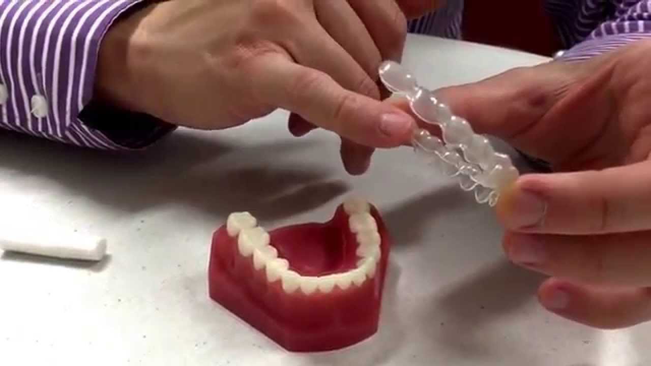 Sharp Edges With Your Invisalign Plates- How And What To Do. Dr Andrew Chang- Smiles \U0026  Faces Ortho