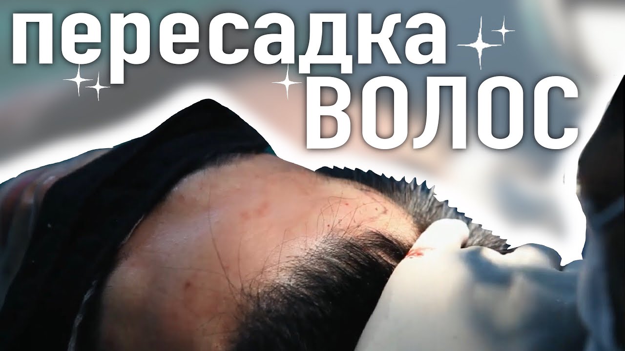 БЕСШОВНАЯ ПЕРЕСАДКА ВОЛОС В КОРЕЕ