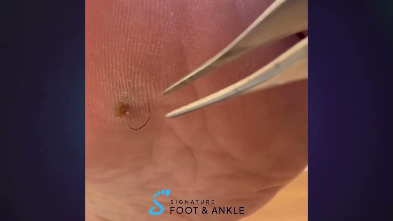 Hair Splinter in the foot YouTube