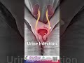 Penis Pain, Burning Urination &amp; Urinary Problems in Men | Dr. Yogesh R. Barapatre Explains |