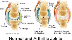 Preventing Arthritis At The Initial Stage | Arthritis Prevention