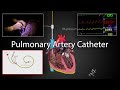 Pulmonary artery catheter (Swan-Ganz Catheter) placement and physiology