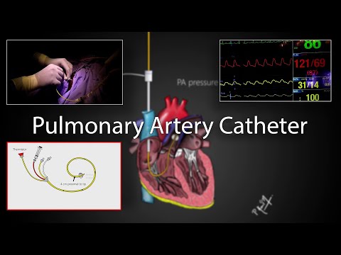 Pulmonary artery catheter (Swan-Ganz Catheter) placement and physiology