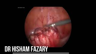 laparoscopic myomectomy (big myoma)استئصال ورم ليفى منظار