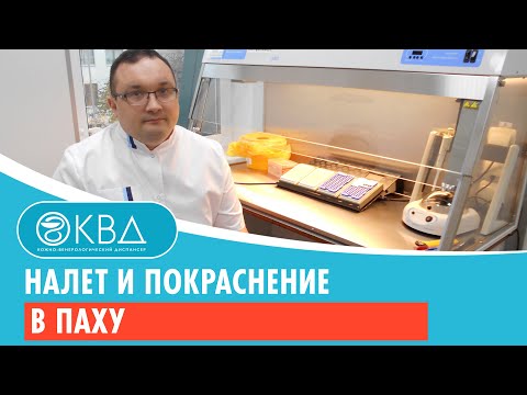 😐 Налет и покраснение в паху. Клинический случай №260