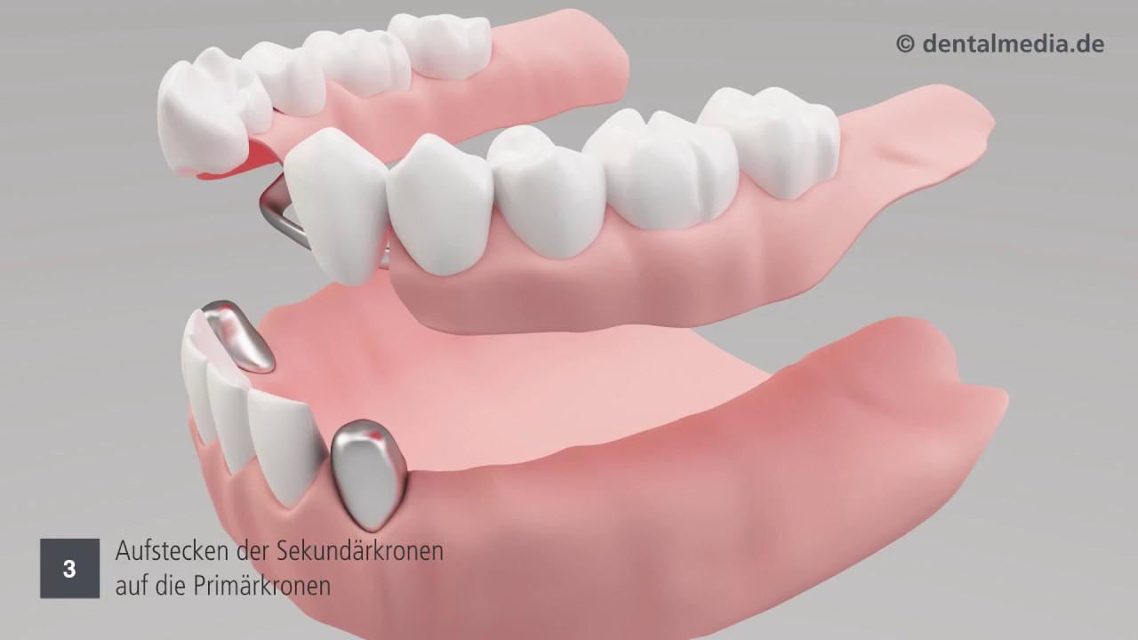 Gaumenplatte mit zahnprothese oberkiefer Zahnprothese Oberkiefer