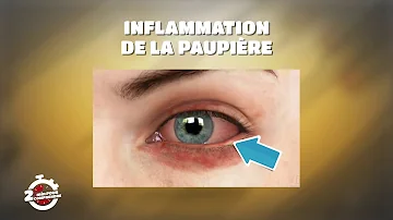 Comment Attrape-t-on une Blepharite ?