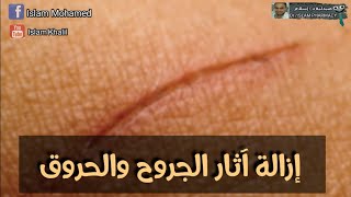 علاج أثار الجروح الندبات بطرق منزليه أقل من 20 جنيه| Scar treatment