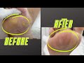 BEFORΕ &amp; AFTER | CORN TREATMENT | CALLUS TREATMENT | ΘΕΡΑΠΕΙΑ ΤΥΛΟΥ | ΘΕΡΑΠΕΙΑ ΚΑΛΟΥ | ΠΡΙΝ &amp; ΜΕΤΑ