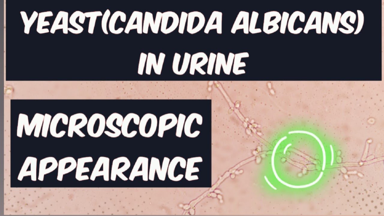 Yeast (Candida Albicans)in Urine Microscopic Appearance Short Video pathologymaster7044
