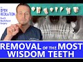 Removal of Eight Wisdom Teeth on One Patient
