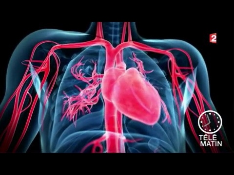 Vidéo: Crise Cardiaque étendue: Qu'est-ce Que C'est, Conséquences, Symptômes, Causes