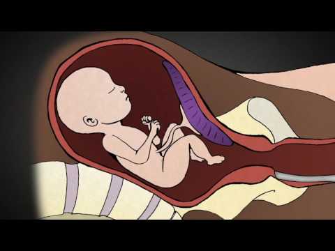 2nd Trimester Medical Abortion