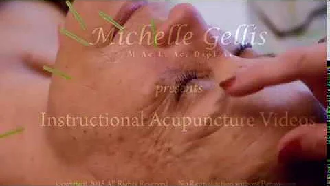 Cosmetic Acupuncture Facial Needling of YuYao taug...