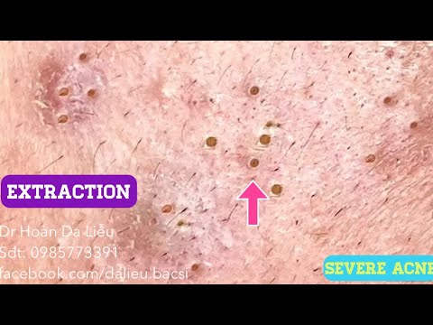 Mụn ẩn đầy mặt|Dermatologist,pimples, whitehead blackhead,anti acne,severe hidden acne removal NTV