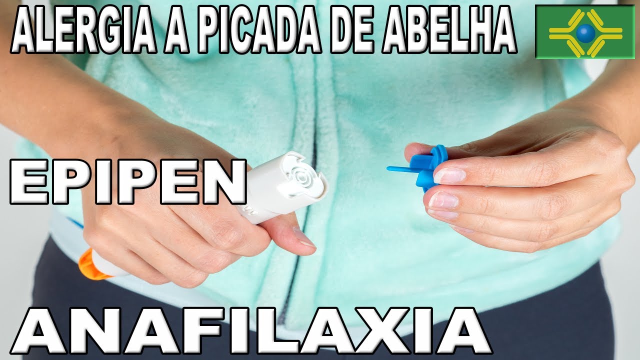 ALERGIA A PICADA DE ABELHA | Tive que usar EPIPEN para não ter ...