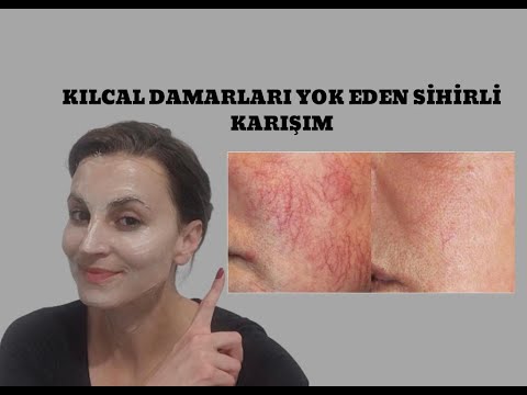 Yüzdeki Kılcal Damarları Yok Eden Kür | Kılcal damarlara Doğal Çözüm | Temiz Bir Cilt için Maske