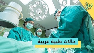 حالات طبية غريبة !! || قناة زدني