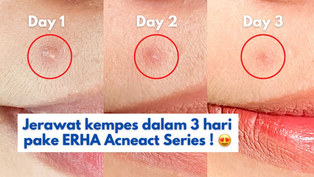 SKINCARE UNTUK MENGHILANGKAN JERAWAT DALAM 3 HARI PAKE ERHA ACNEACT