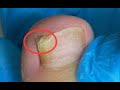 Toenail edge is too hard for cut and ask for help