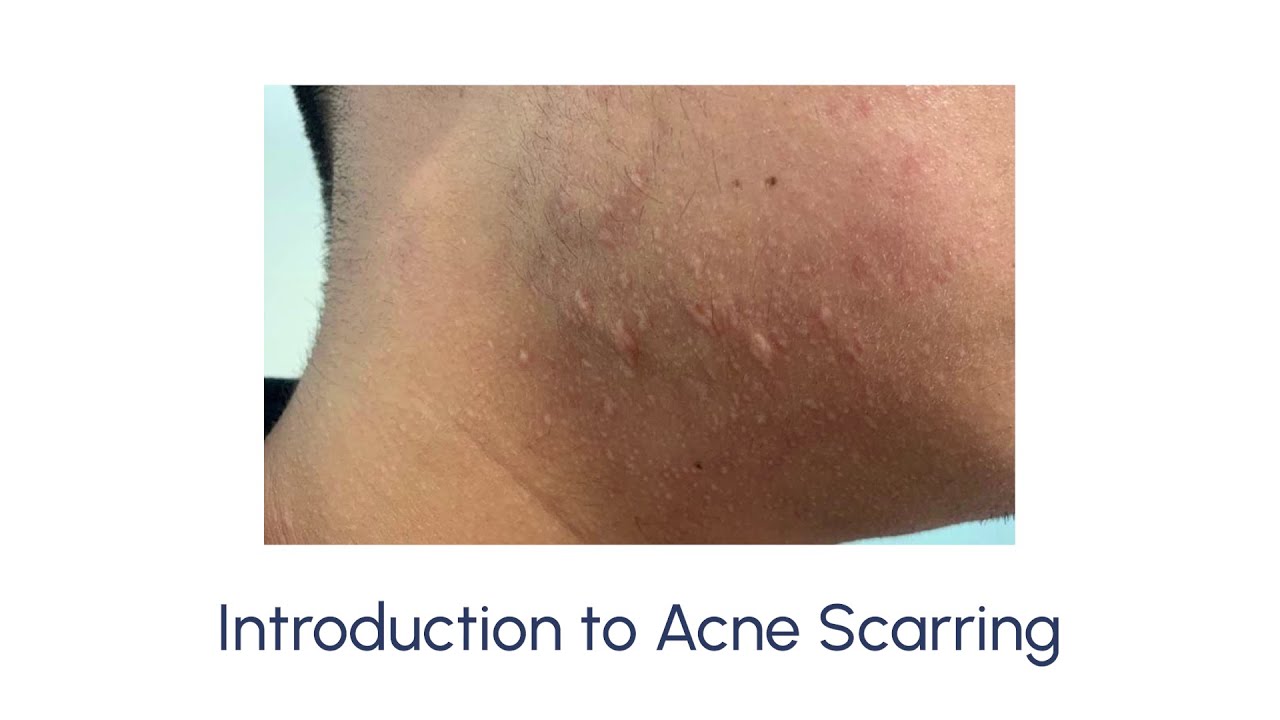 How to Treat Acne Scars