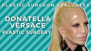 Donatella Versace Before and After Plastic Surgery: Silicone Disaster?!