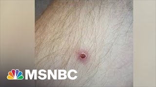 Let’s Talk About Monkeypox | Zerlina.