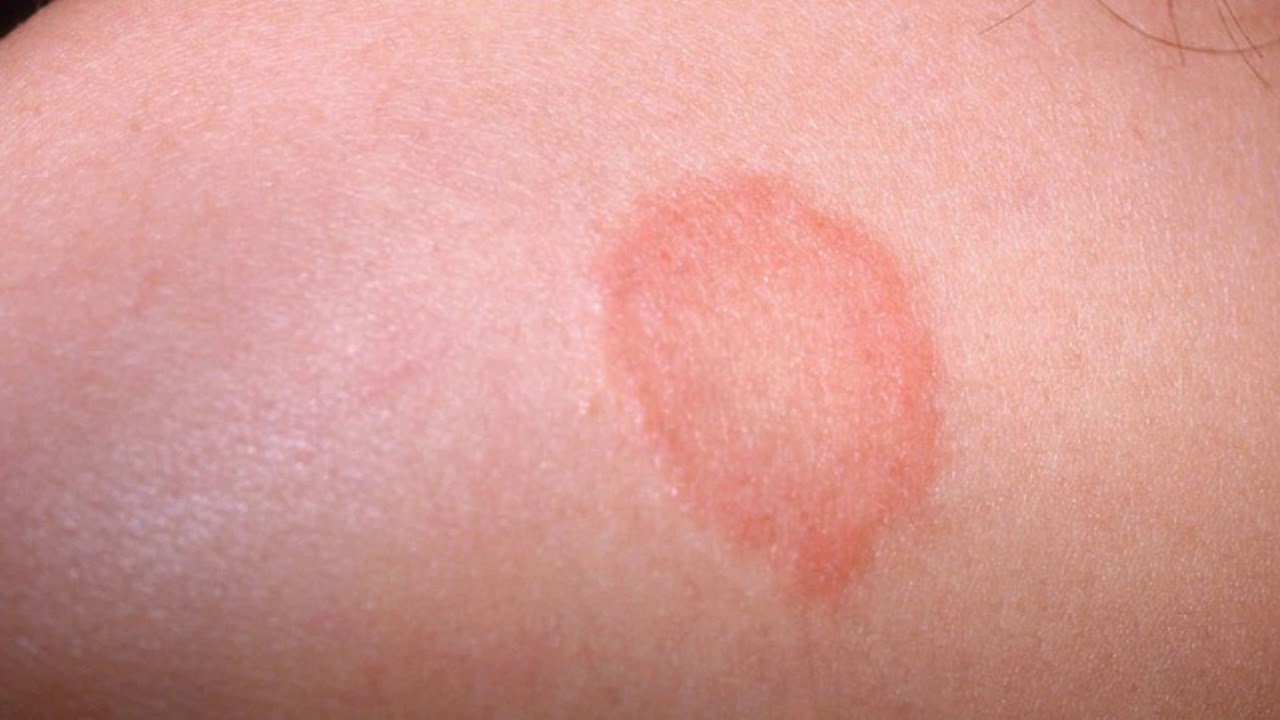 Difference Between Eczema And Ringworm Youtube