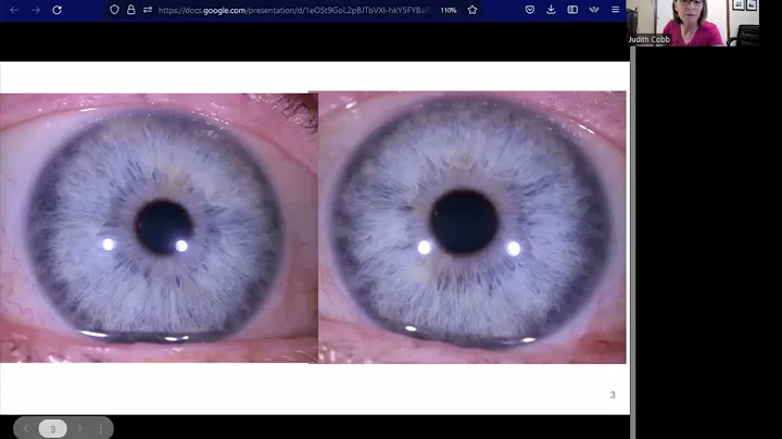 Iridology: Iris Fiber...transver...