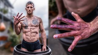 Thumbnail for Rehabilitation statt Amputation - Wird meine Hand wieder 100% funktionieren?