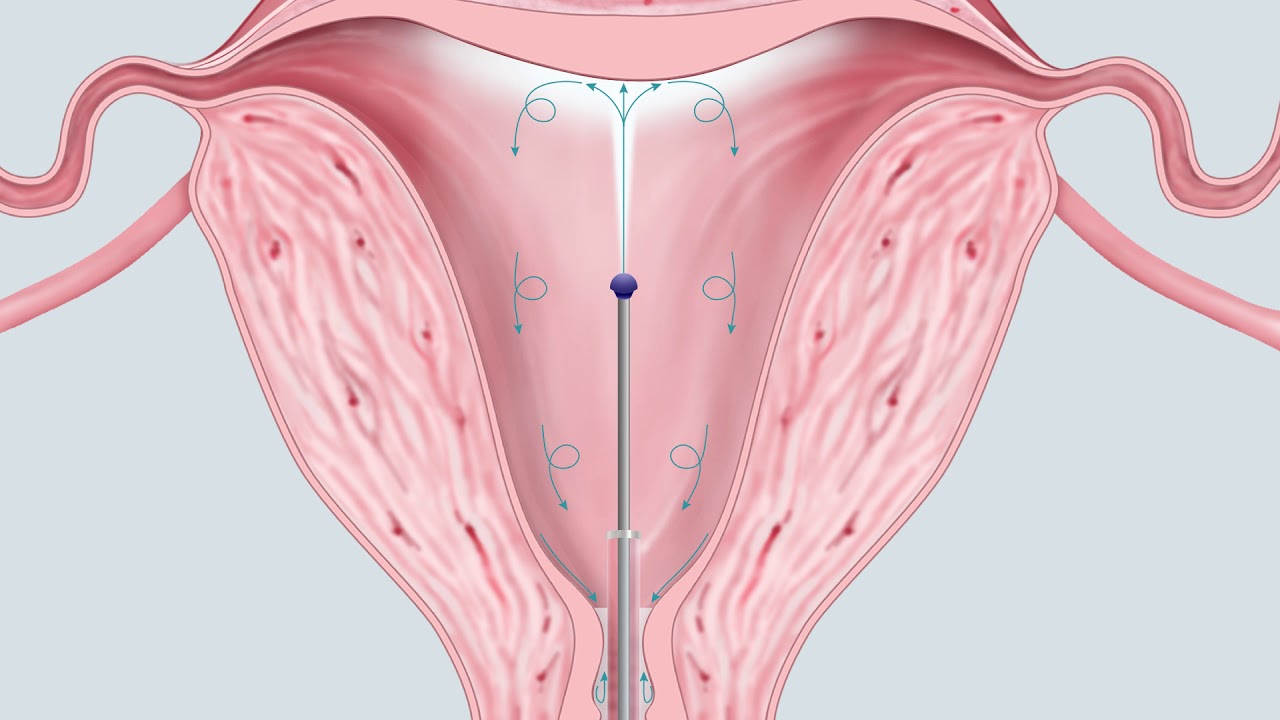 Previvo Uterine Lavage Procedure (Animation) YouTube