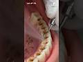 Edge Erosion Crisis 😨 | Gumline Decay &amp; Exposed Dentin Restoration | Satisfying Dental Fix #ai