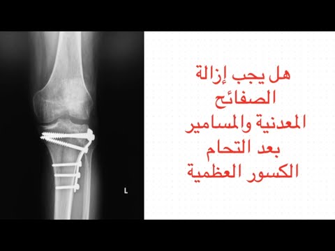 هل يجب إزالة الصفائح المعدنية والمسامير بعد التحام كسور العظام