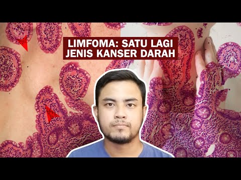 Video: Adakah ketulan limfoma kelihatan?