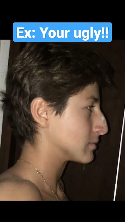 3.5 years of mewing transformation 🥶